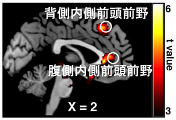 自閉症の対人コミュニケーション障害はホルモン投与で改善できる!? - 東大