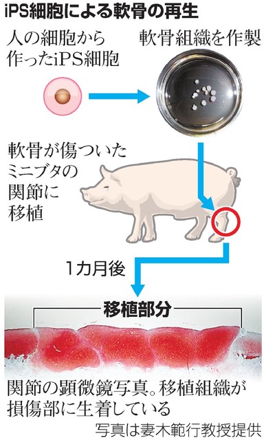 アピタルトップ > ニュース > 治りにくい軟骨、iPSで作製 京大「4年内に臨床へ」