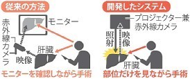 肝臓がん手術:切除部位照らす新技術 京大、プロジェクションマッピングを応用
