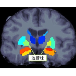 脳の特定部体積に左右差 統合失調症患者、阪大など発見