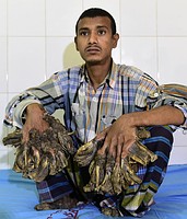 表皮異常「手足が木に」＝奇病の男性手術へ－バングラ