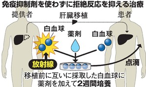 生体肝移植の拒絶反応、薬なしで長期抑制 北大など発表